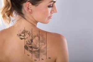 Expert Tattoo Removal with Laser Technology